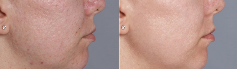 Stretch mark removal service results showing smoother refined skin texture