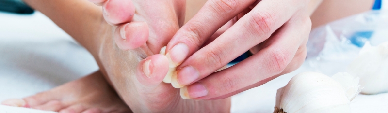 Verruca removal treatment on foot at DSL Clinic