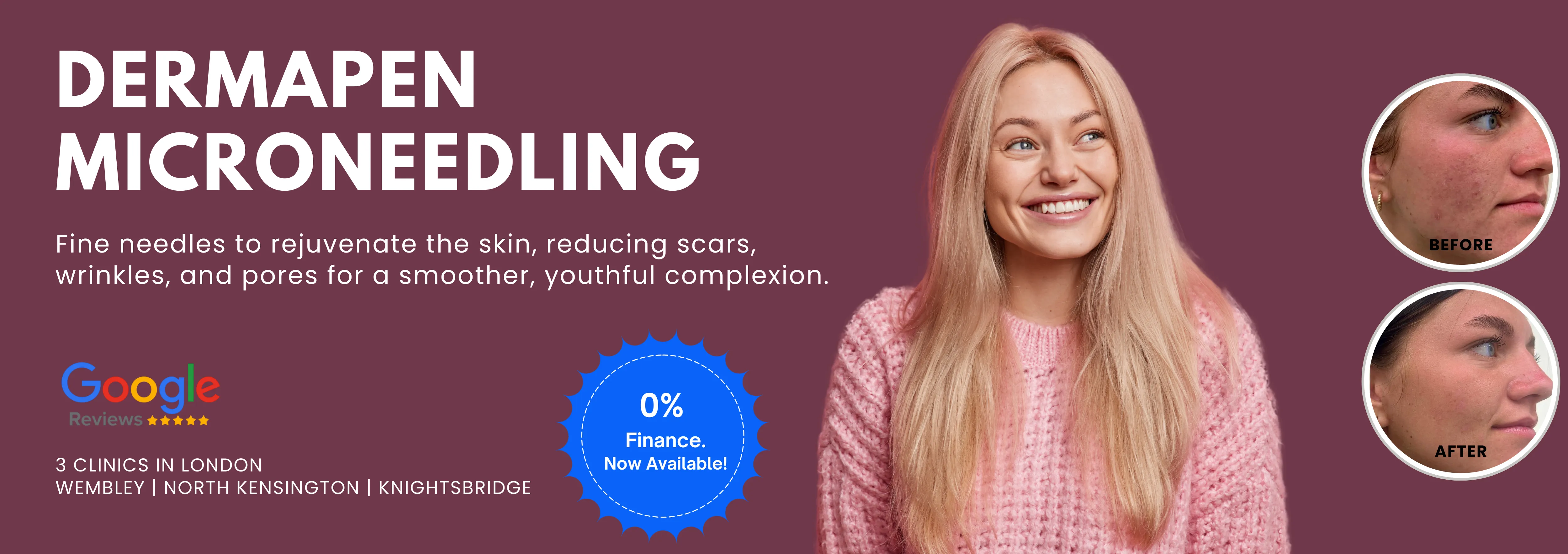 Dermapen Microneedling