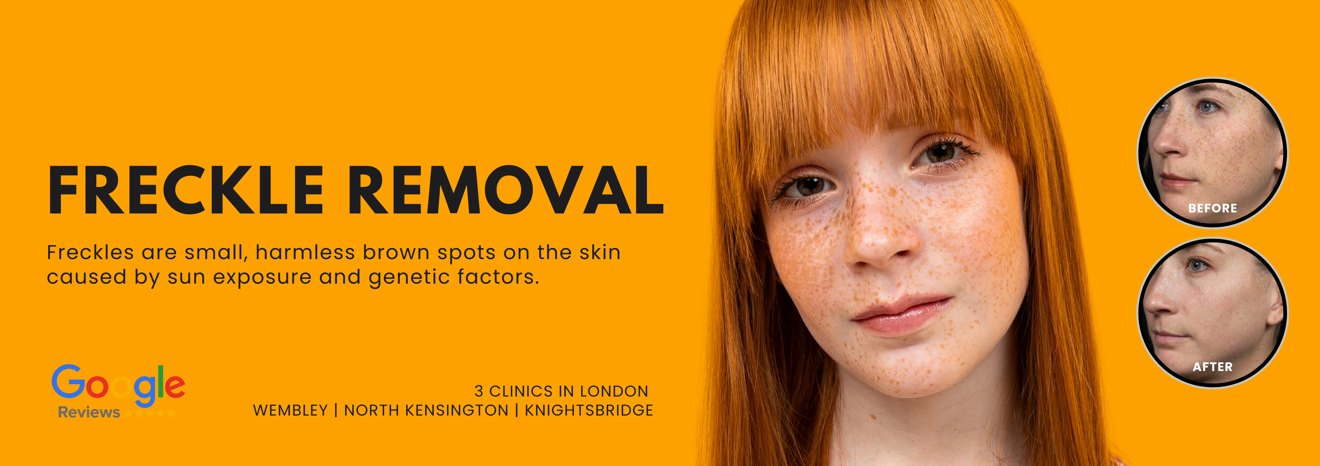 Freckle Removal