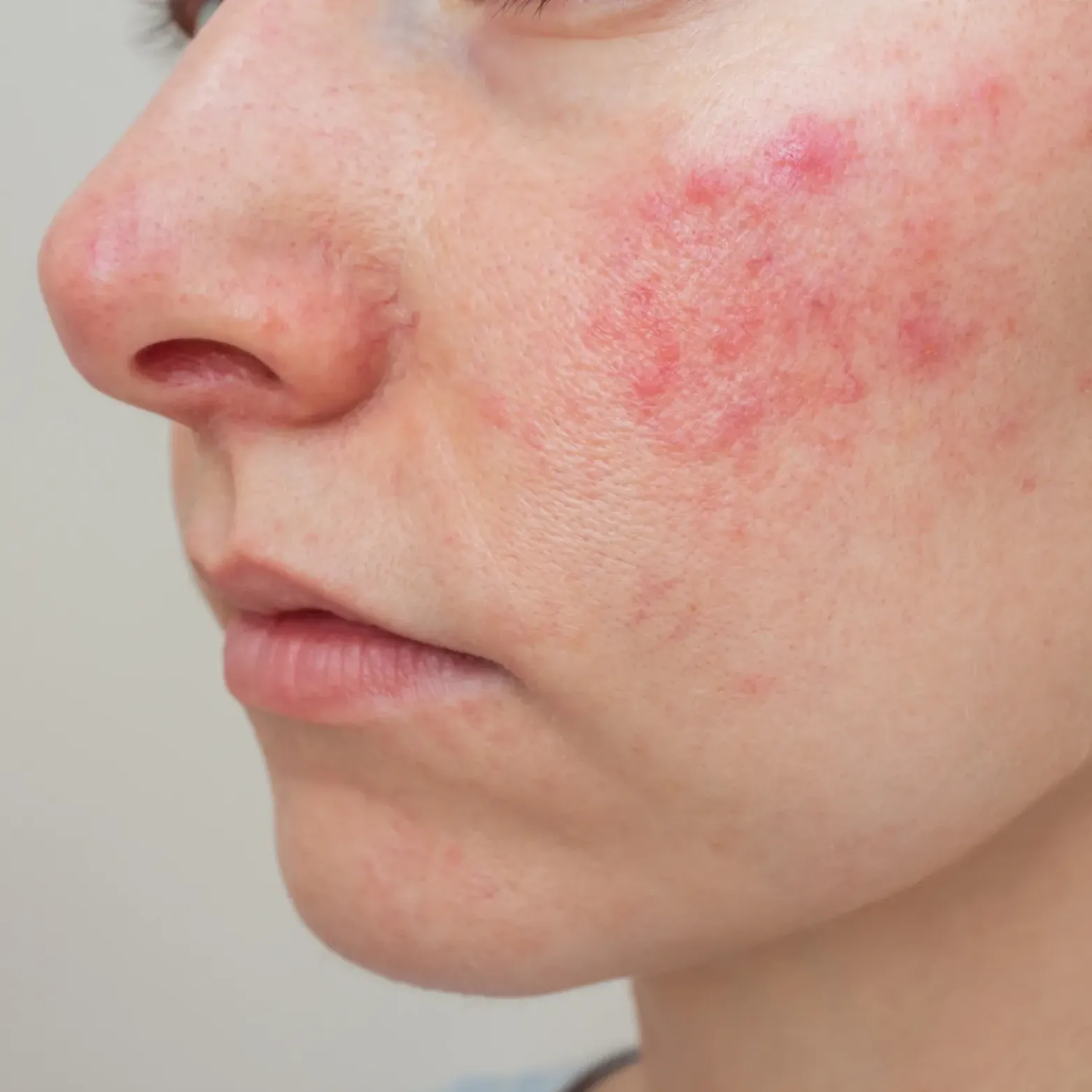 Rosacea Treatments London