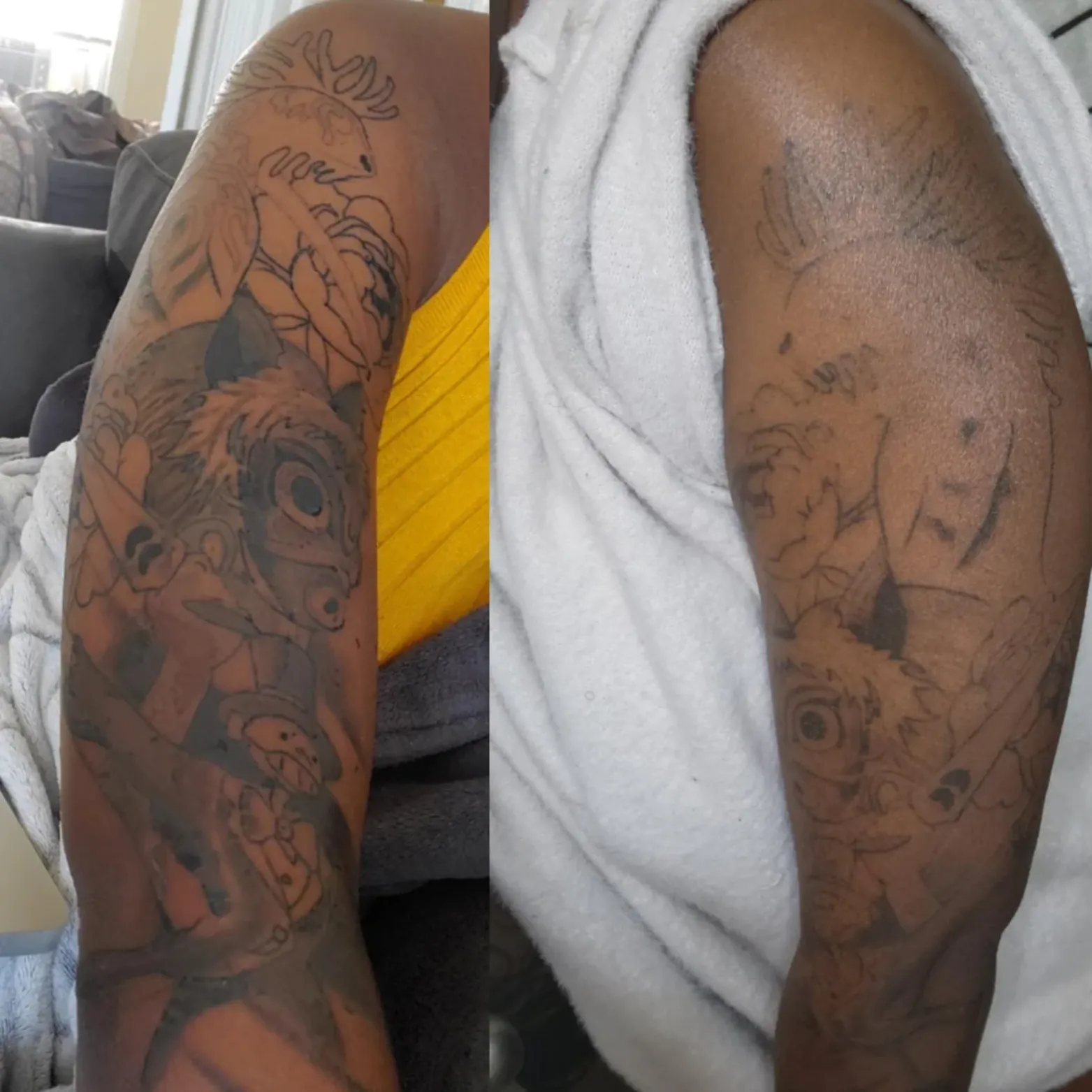 Laser Tattoo  Removal For Dark Skin