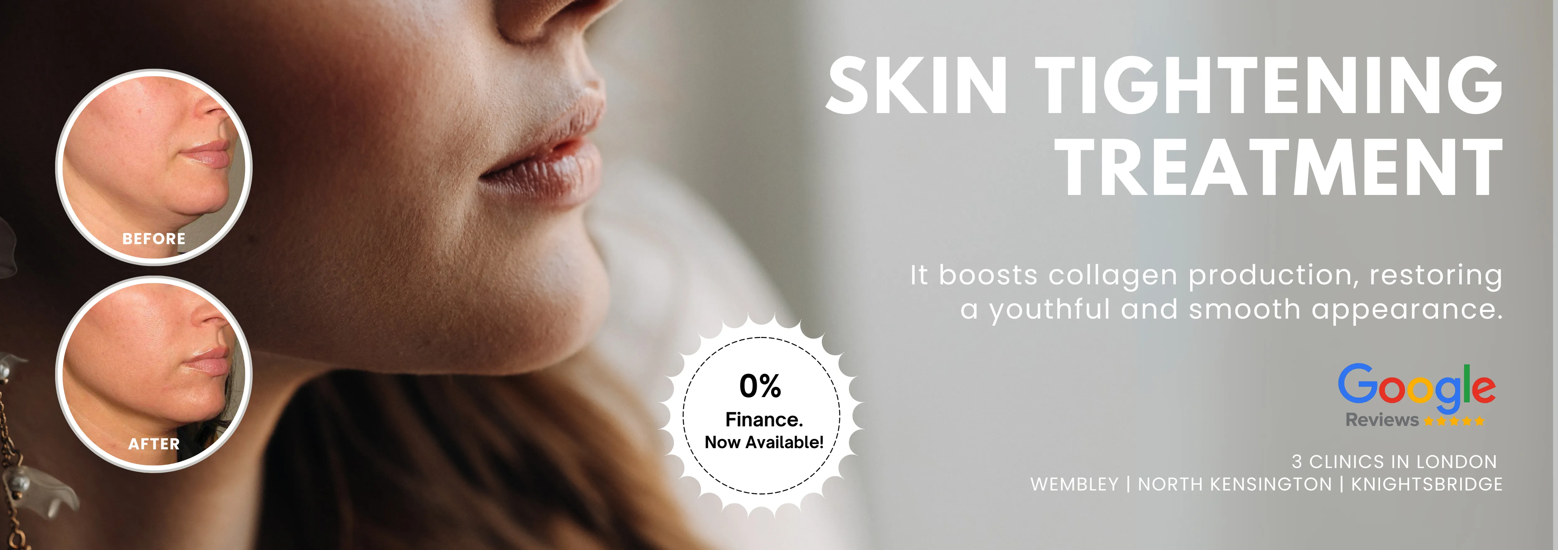 Skin Tightening Treatments