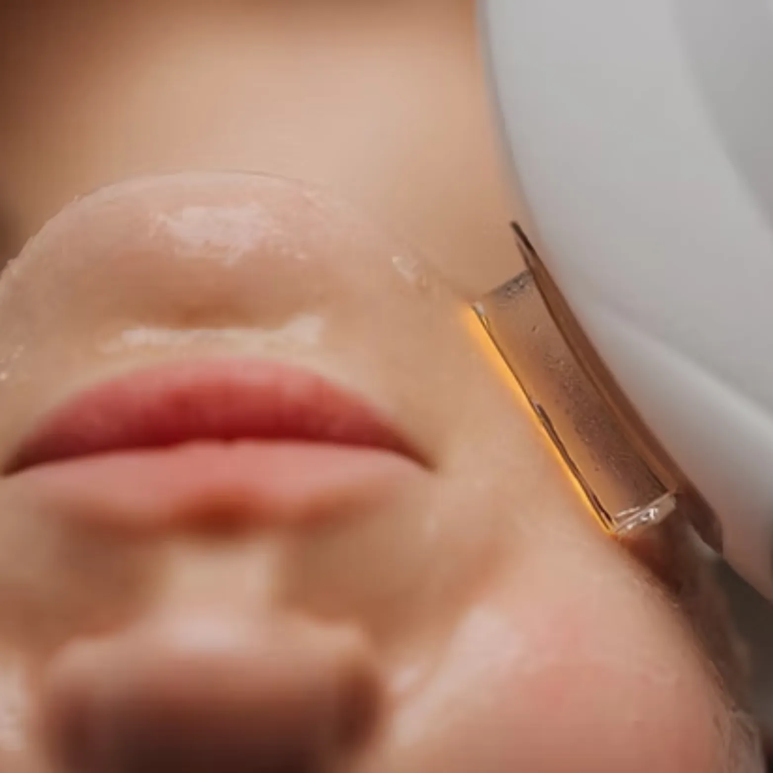 IPL Treatment with Nordlys New