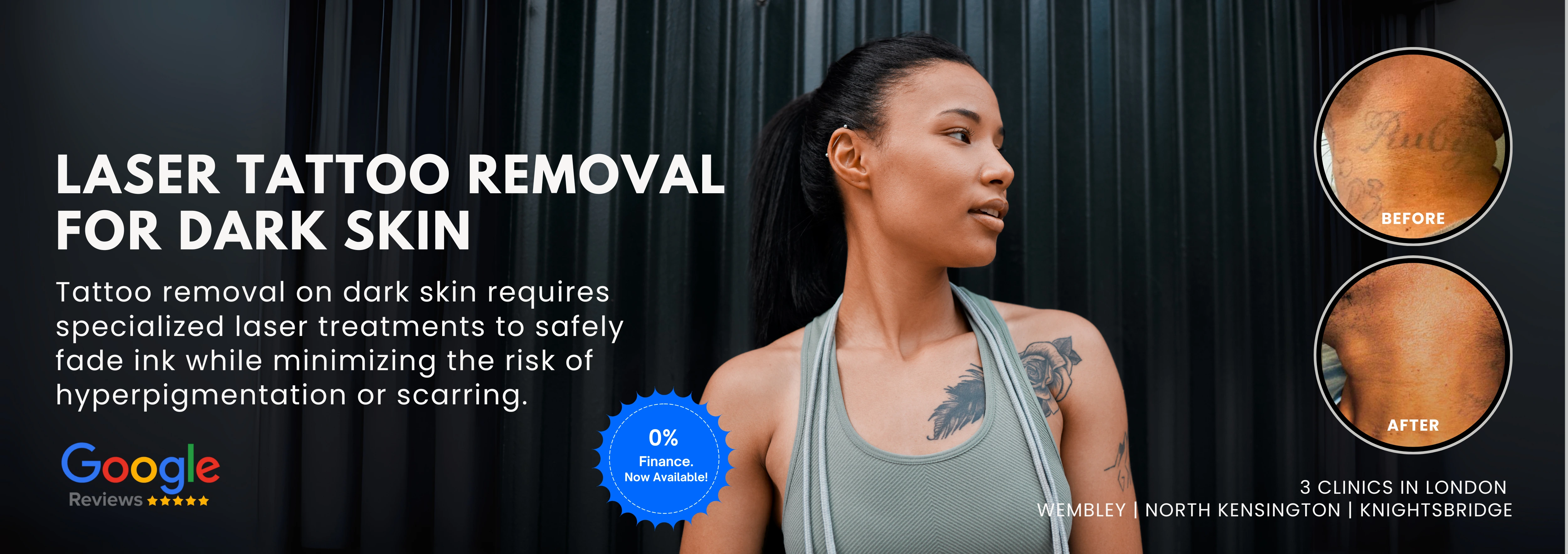 Laser Tattoo  Removal For Dark Skin