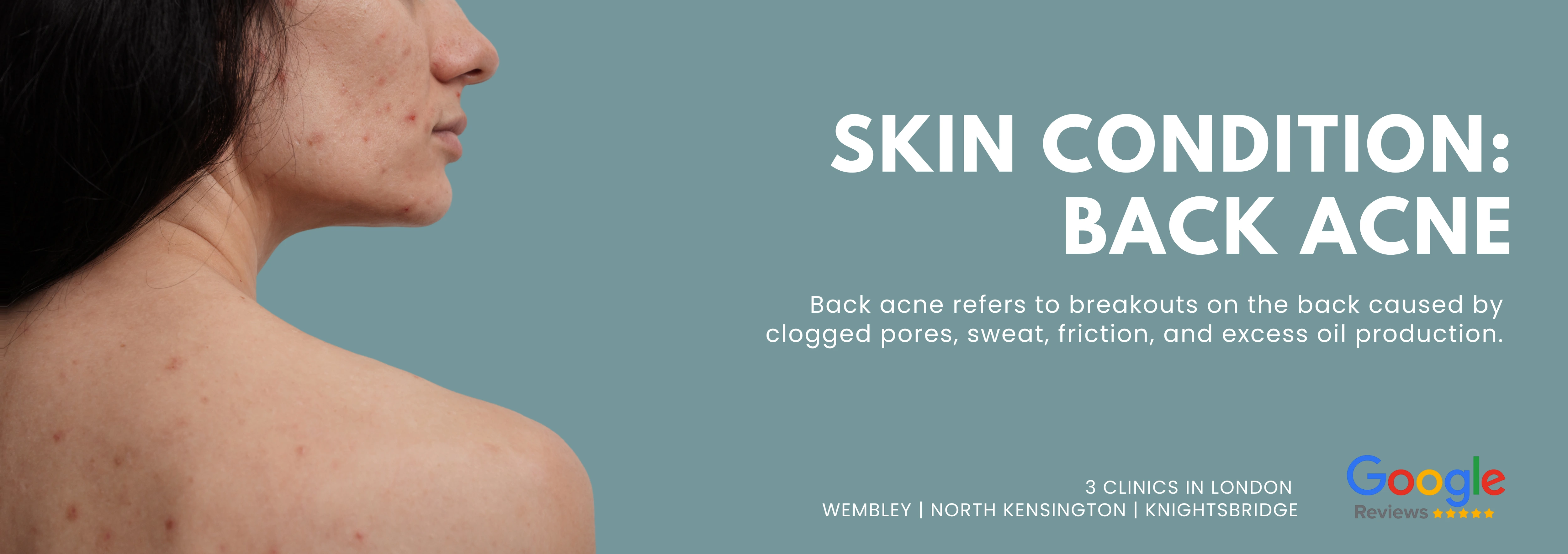 Back Acne