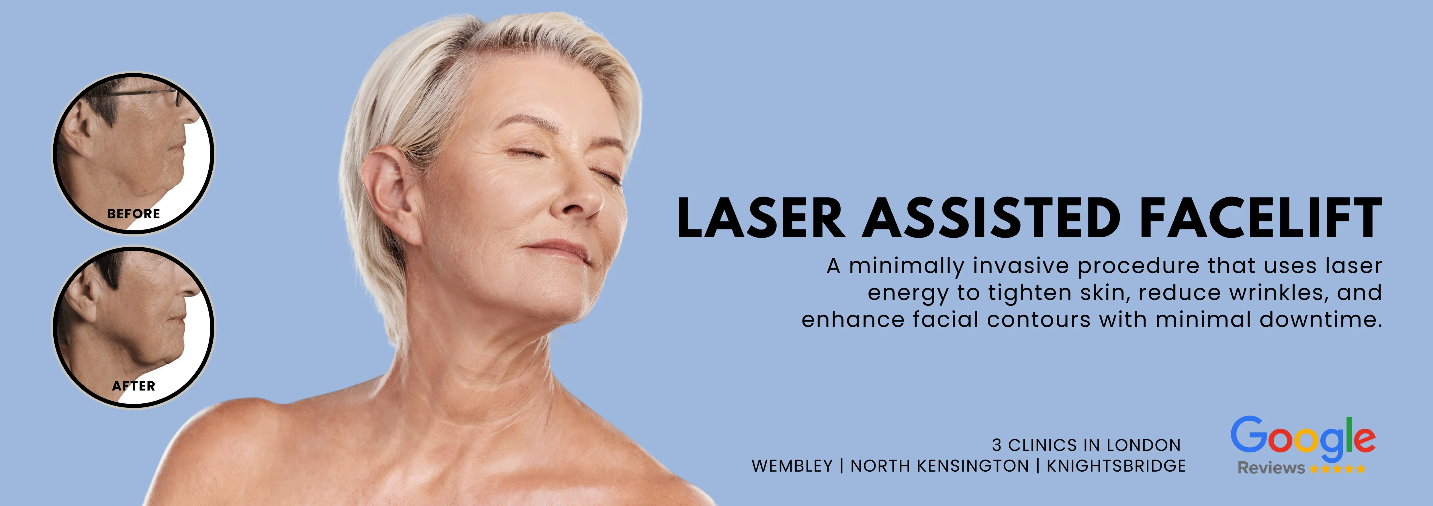 Laser Assisted Facelift