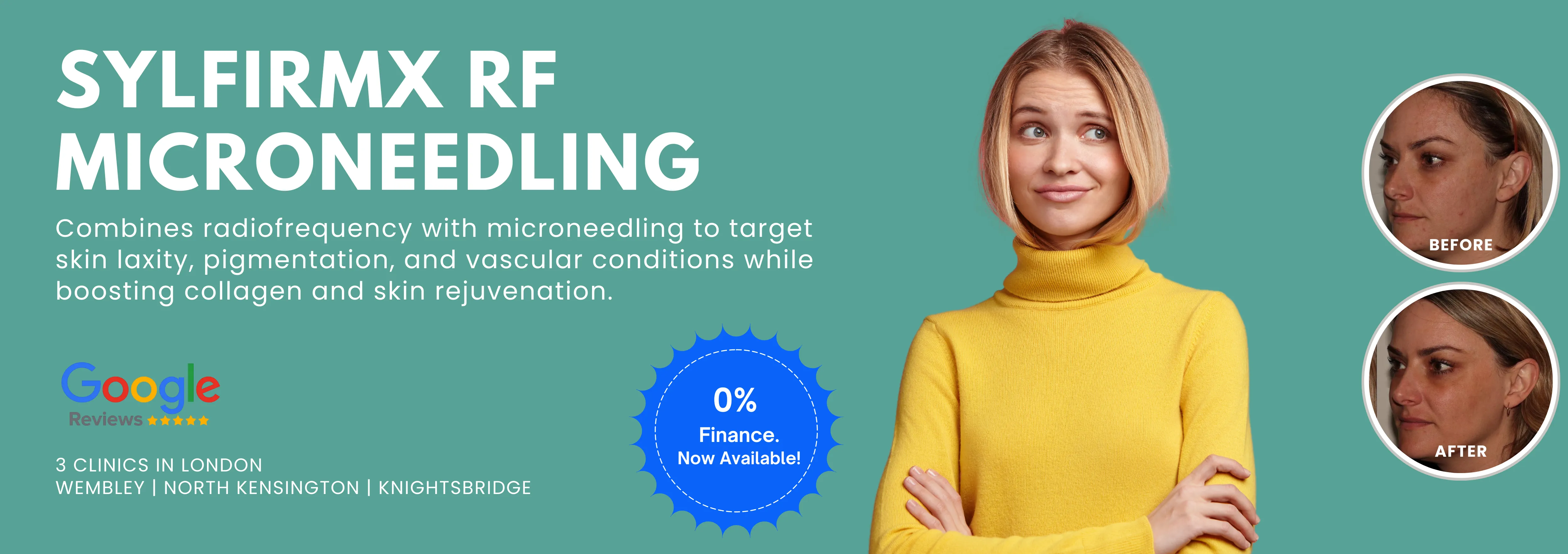 RF Microneedling Treatment