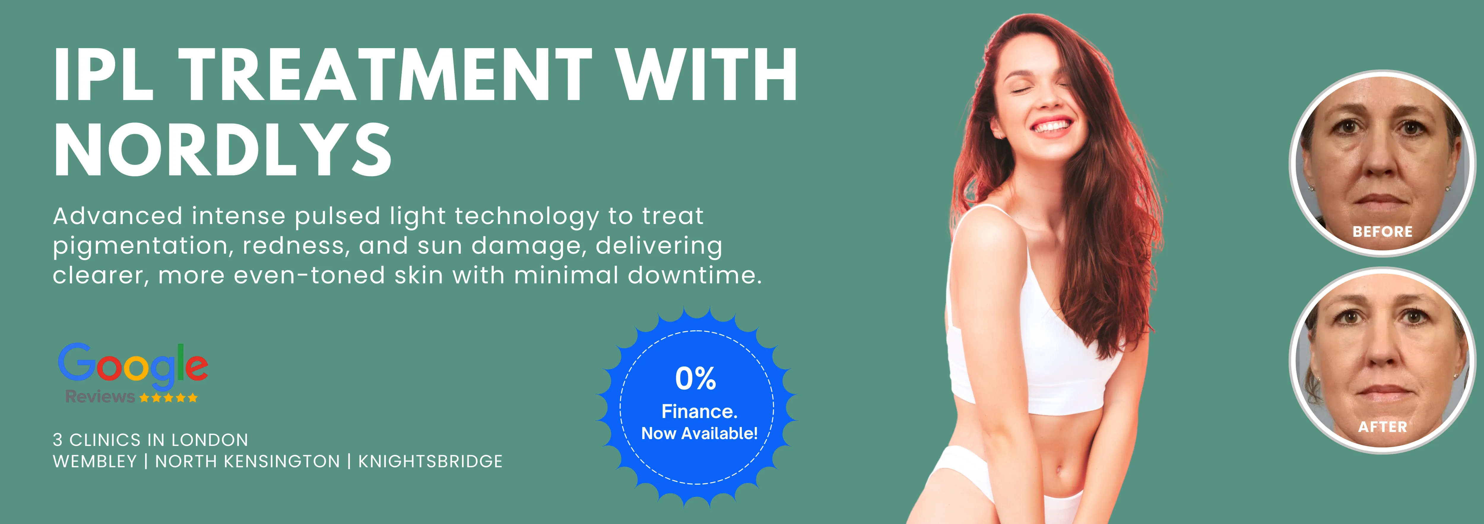 IPL Treatment with Nordlys New