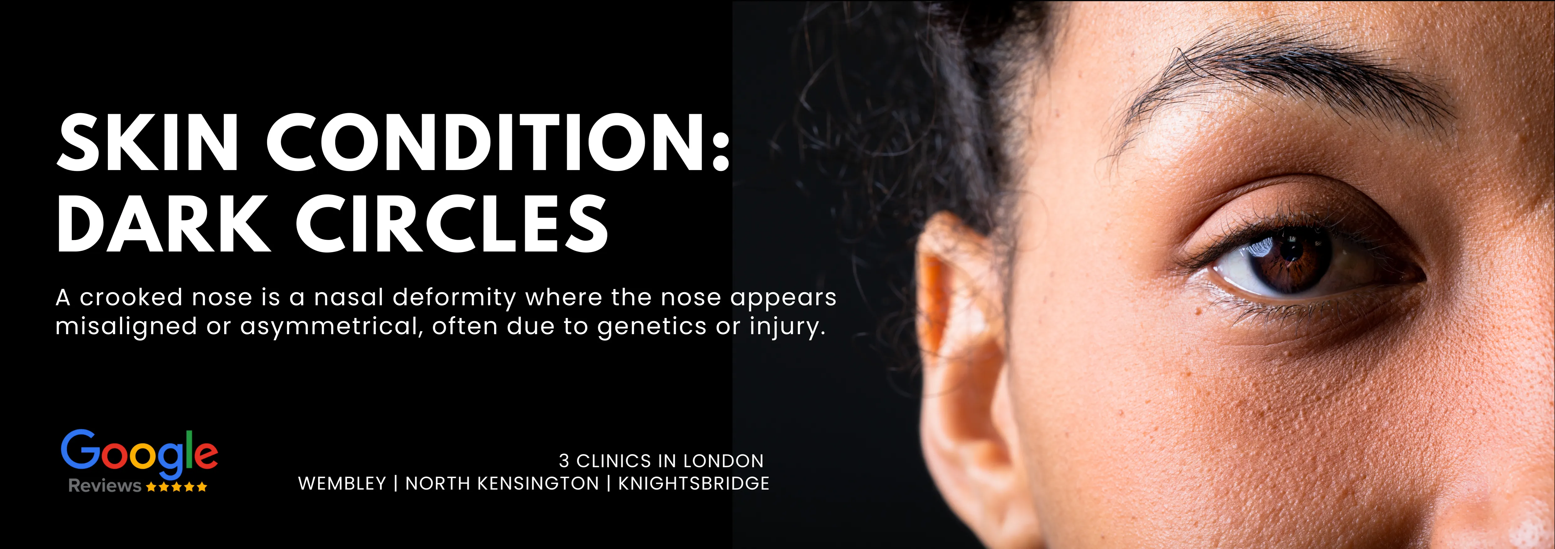 Dark Circles (Under Eye)