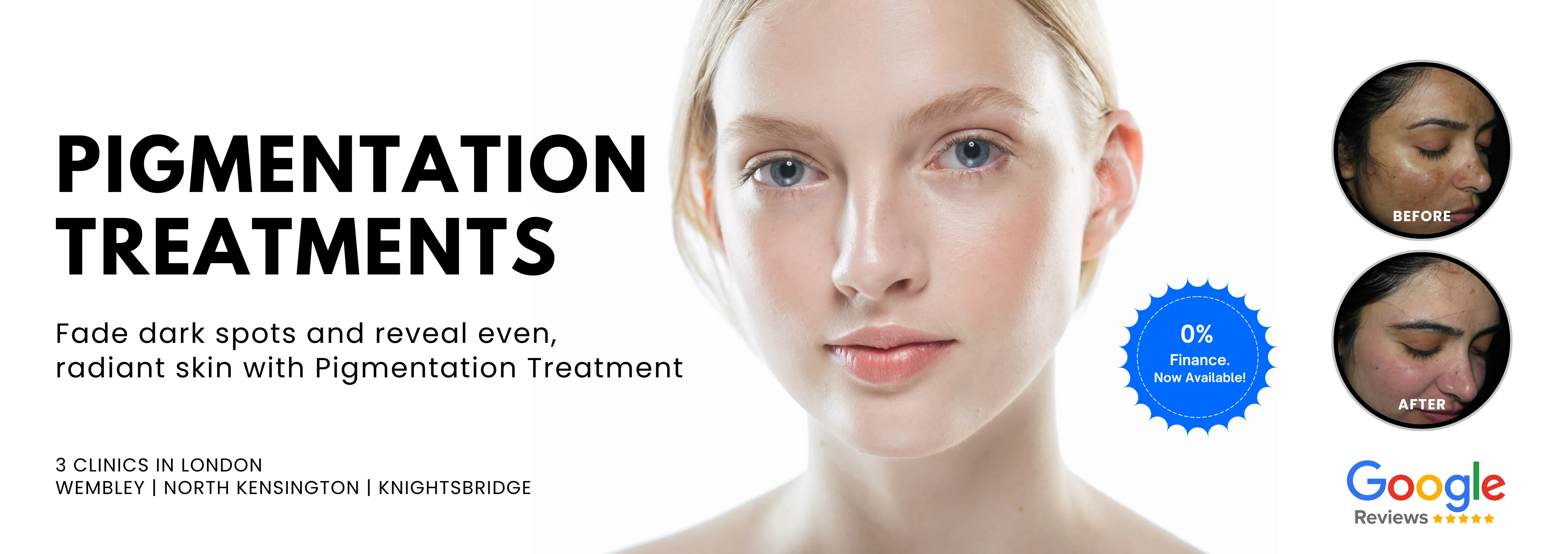 Pigmentation Treatment London