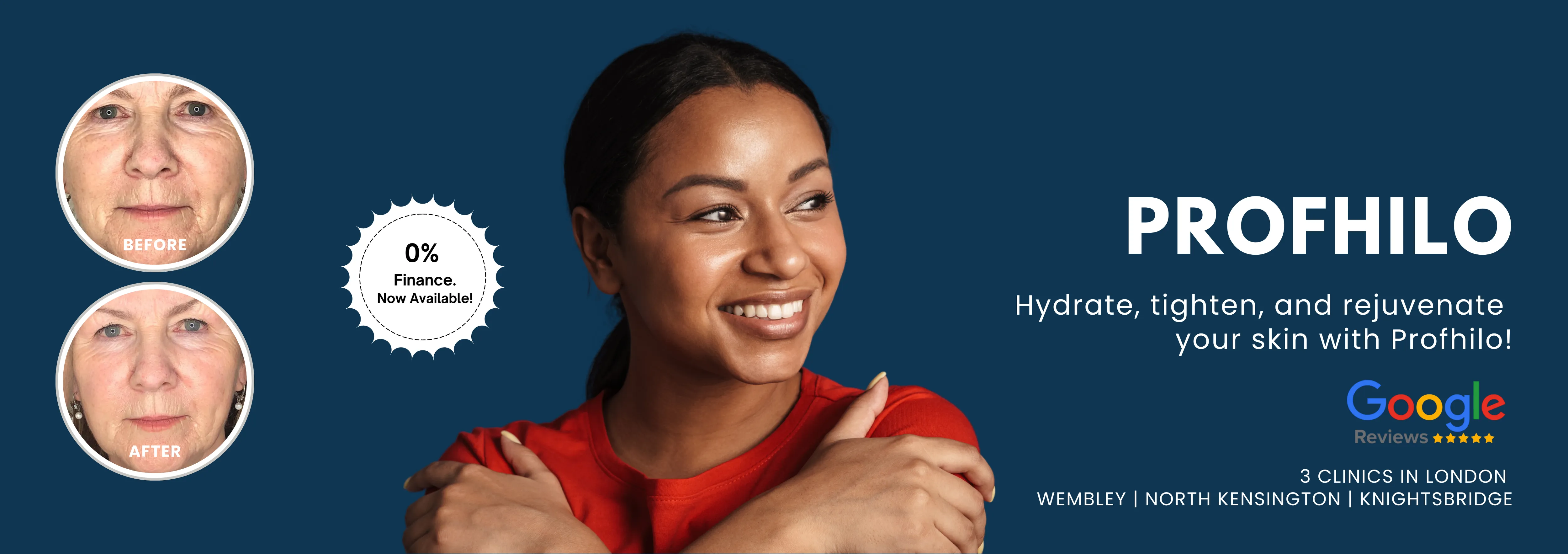Profhilo Treatment London