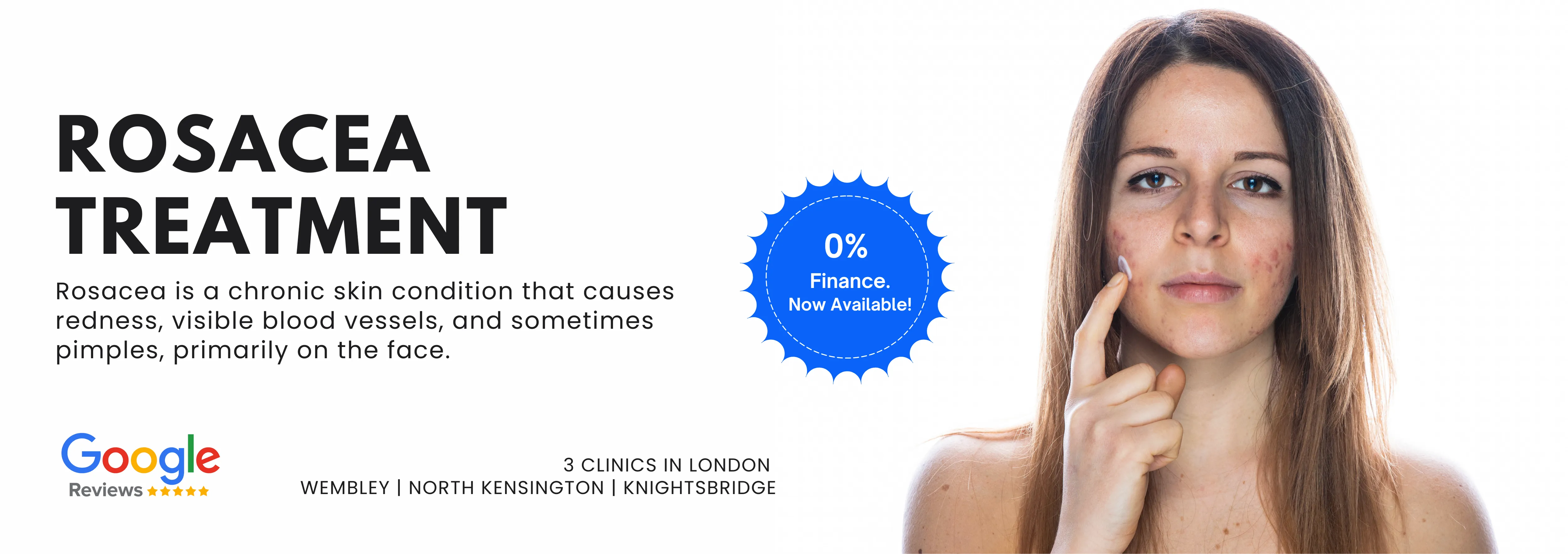 Rosacea Treatments London